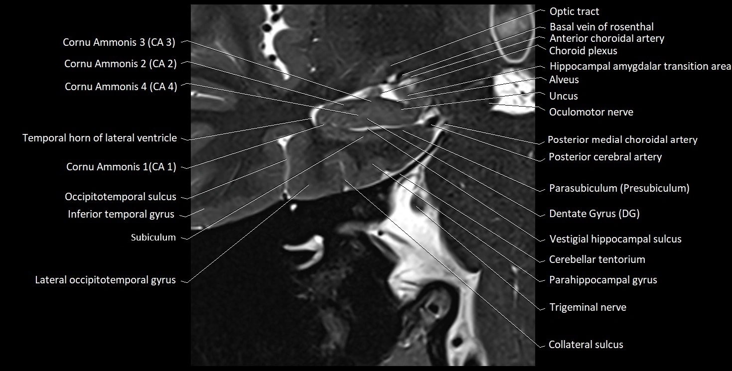 Hippocampus anatomy mri coronal cross section 3T MRI image 5.webp